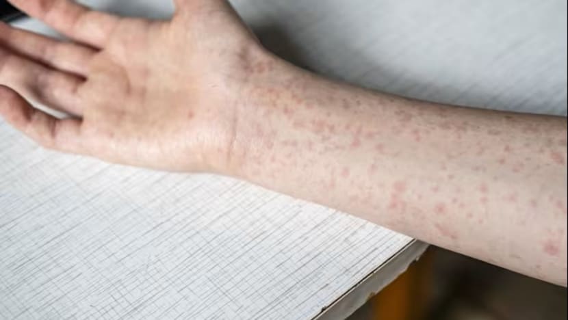 measles.jpg