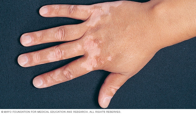 vitiligo-sopak.jpg